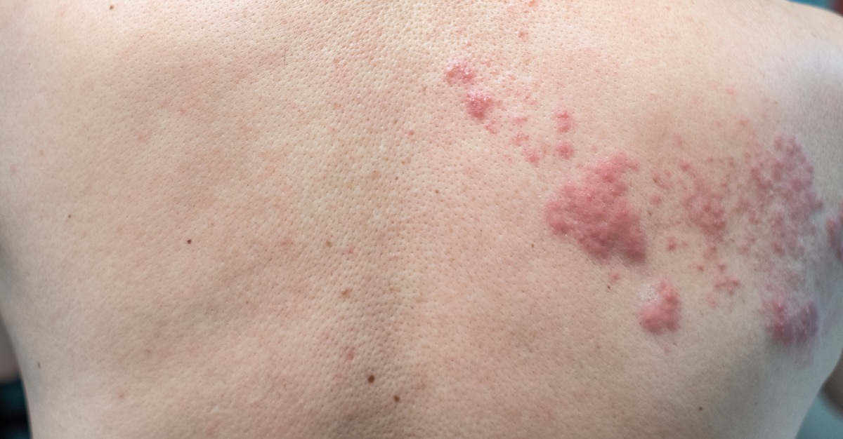 Can Shingles Cause Nerve Damage Passport Health